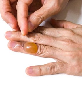 FDA approves redosable gene therapy to treat DEB