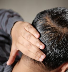 Niostem: een niet-invasieve draagbare oplossing voor mensen met haarverlies