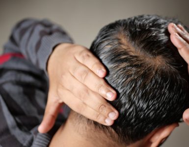 Niostem: een niet-invasieve draagbare oplossing voor mensen met haarverlies
