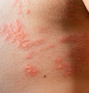 GSK announces new Shingrix data demonstrate 100% vaccine efficacy in the prevention of shingles in adults aged 50 and over in China