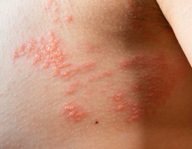 GSK announces new Shingrix data demonstrate 100% vaccine efficacy in the prevention of shingles in adults aged 50 and over in China