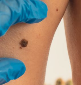 Melanoma Research Alliance applauds US FDA approval of first cellular therapy in melanoma