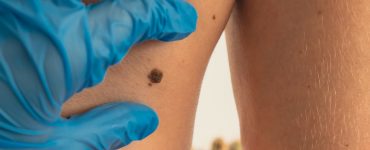 Melanoma Research Alliance applauds US FDA approval of first cellular therapy in melanoma