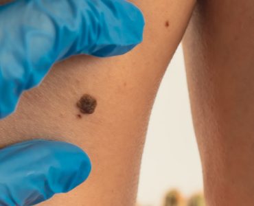 Melanoma Research Alliance applauds US FDA approval of first cellular therapy in melanoma