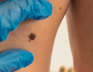 Melanoma Research Alliance applauds US FDA approval of first cellular therapy in melanoma