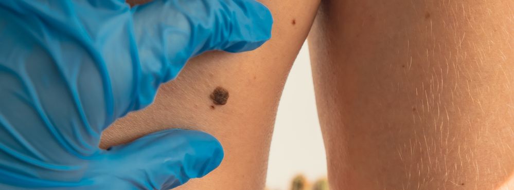 Melanoma Research Alliance applauds US FDA approval of first cellular therapy in melanoma
